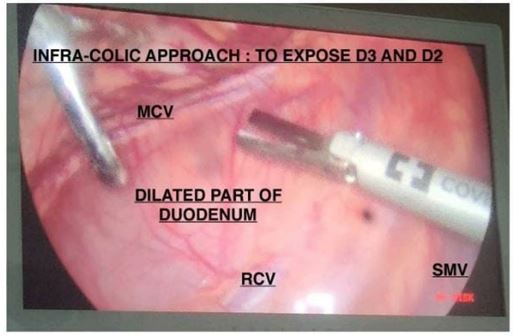 Laparoscopic Duodenojejunal Bypass for Superior Mesenteric Artery Syndrome after Failed Medical Mana...