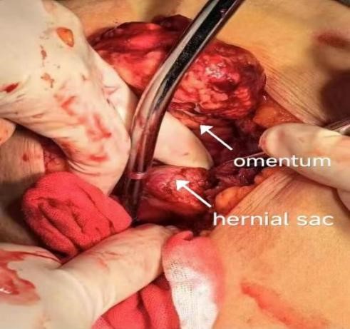 Surgical Management of Congenital Transdiaphragmatic Hernia with Abdominal Wall Involvement in an Ad...