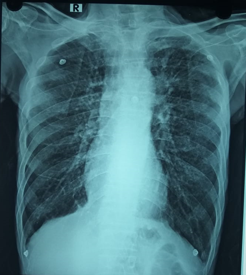 81-Year-Old Male Diagnosed Acute Exacerbation of Chronic Obstructive Pulmonary Disease (AECOPD) With...