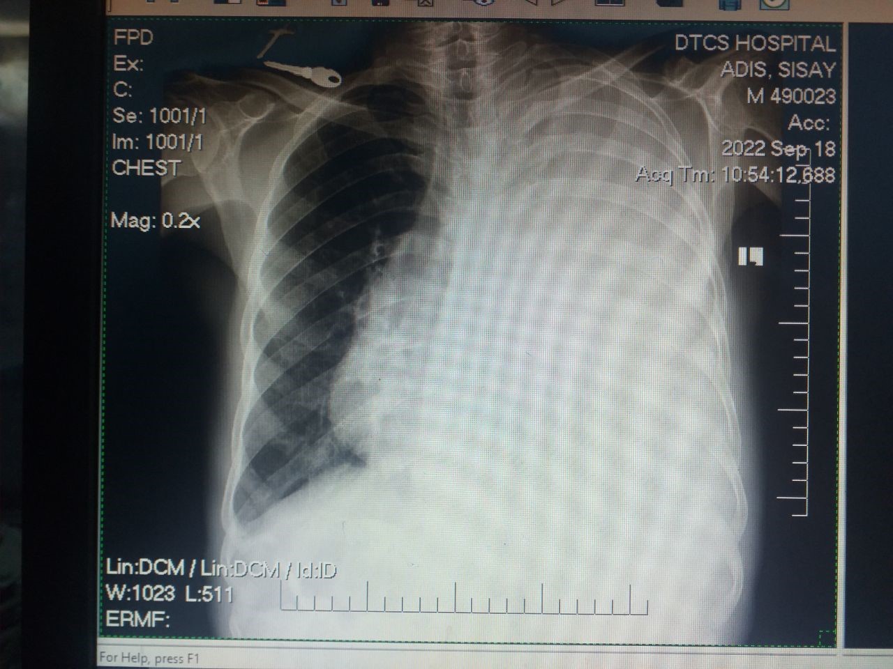 Unilateral Massive Pleural Effusion Occupying the whole Hemithorax Due to Tuberculosis: A Rare form ...