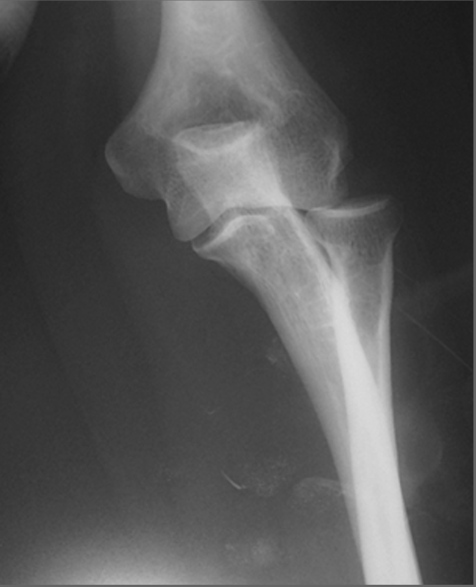 Isolated Luxation of Radial Head: Case Report and Review of the Literature